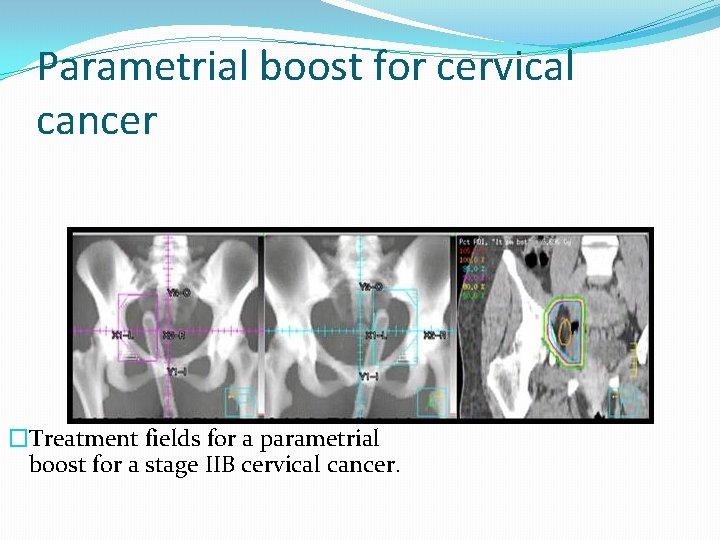 Parametrial boost for cervical cancer �Treatment fields for a parametrial boost for a stage Parametrial boost for cervical cancer �Treatment fields for a parametrial boost for a stage