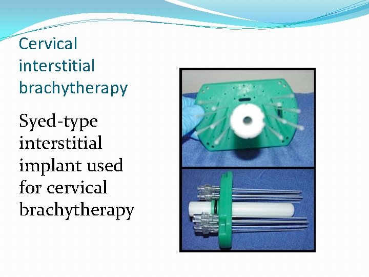 Cervical interstitial brachytherapy Syed-type interstitial implant used for cervical brachytherapy Cervical interstitial brachytherapy Syed-type interstitial implant used for cervical brachytherapy
