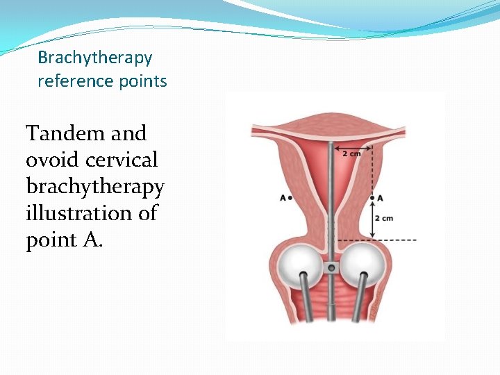 Brachytherapy reference points Tandem and ovoid cervical brachytherapy illustration of point A. Brachytherapy reference points Tandem and ovoid cervical brachytherapy illustration of point A.