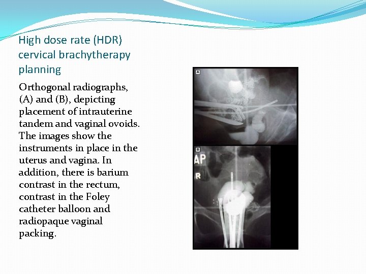 High dose rate (HDR) cervical brachytherapy planning Orthogonal radiographs, (A) and (B), depicting placement High dose rate (HDR) cervical brachytherapy planning Orthogonal radiographs, (A) and (B), depicting placement