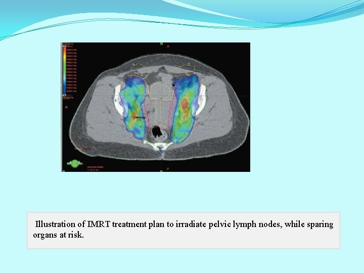 Illustration of IMRT treatment plan to irradiate pelvic lymph nodes, while sparing organs at Illustration of IMRT treatment plan to irradiate pelvic lymph nodes, while sparing organs at