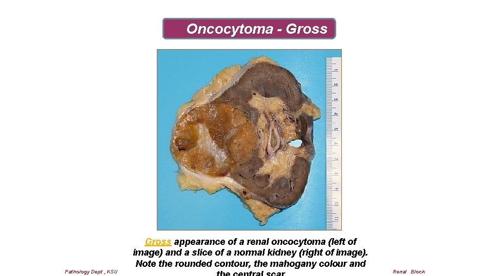 Oncocytoma - Gross appearance of a renal oncocytoma (left of image) and a slice