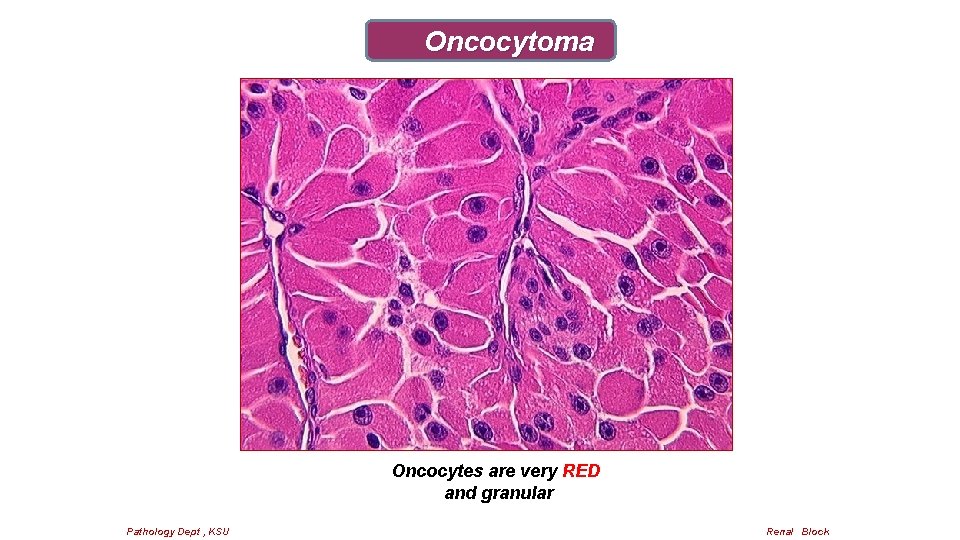 Oncocytoma Oncocytes are very RED and granular Pathology Dept , KSU Renal Block 