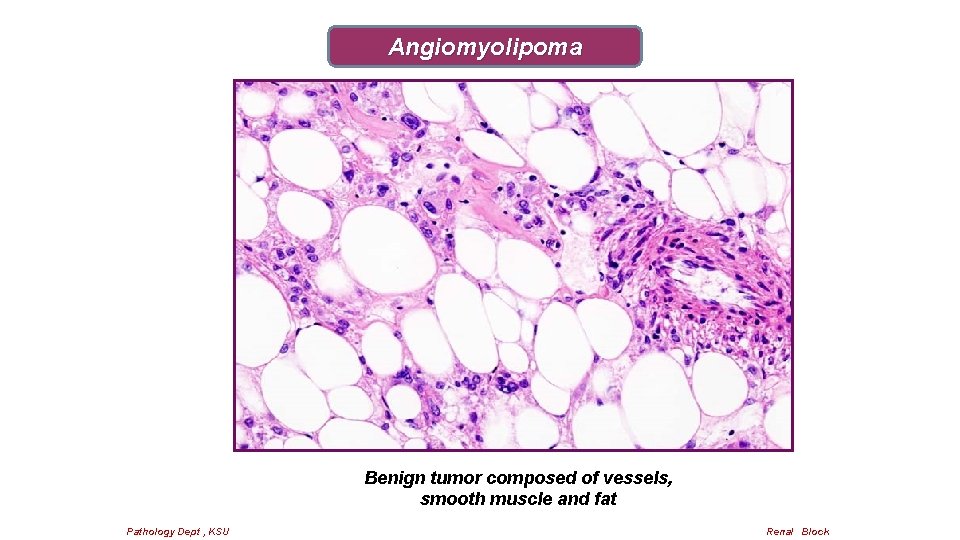 Angiomyolipoma Benign tumor composed of vessels, smooth muscle and fat Pathology Dept , KSU