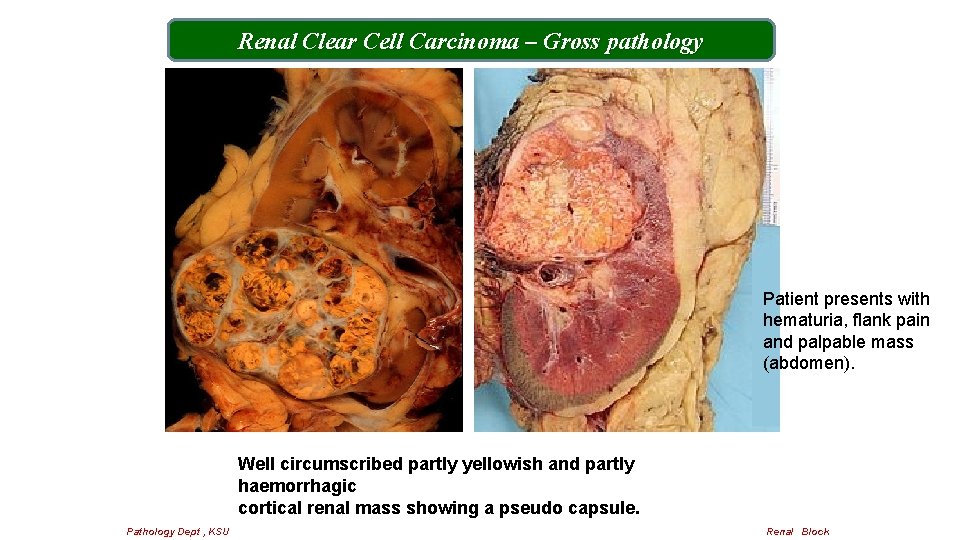 Renal Clear Cell Carcinoma – Gross pathology Patient presents with hematuria, flank pain and