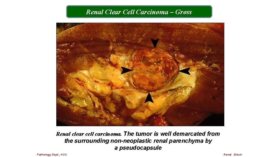 Renal Clear Cell Carcinoma – Gross Renal clear cell carcinoma. The tumor is well