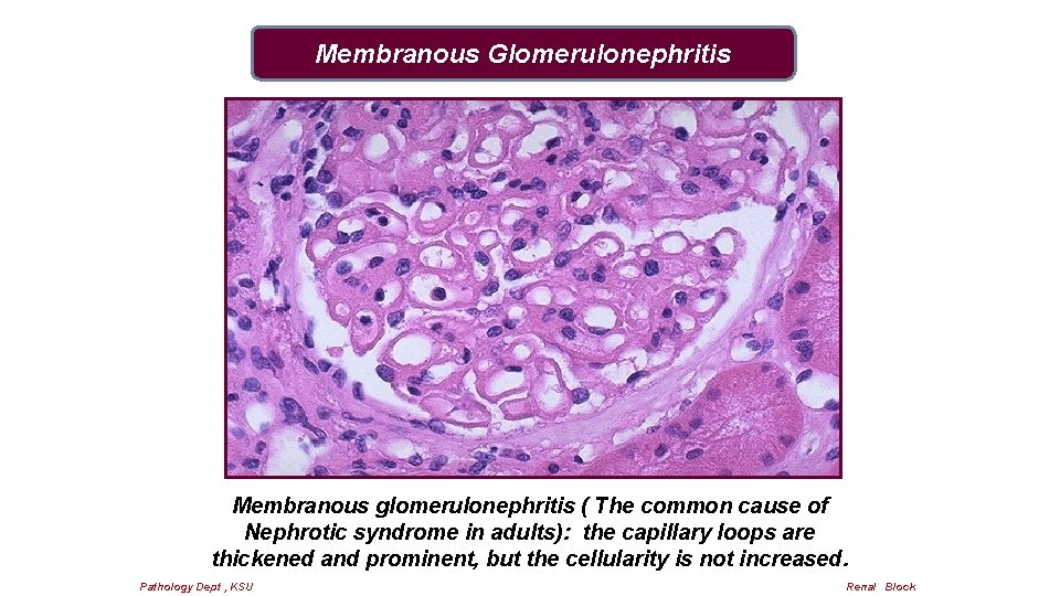 Membranous Glomerulonephritis Membranous glomerulonephritis ( The common cause of Nephrotic syndrome in adults): the