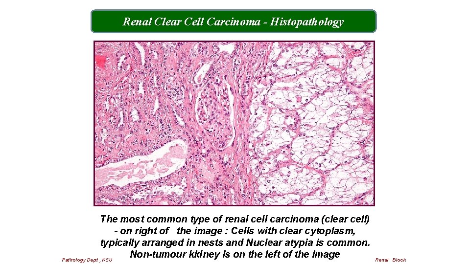 Renal Clear Cell Carcinoma - Histopathology The most common type of renal cell carcinoma
