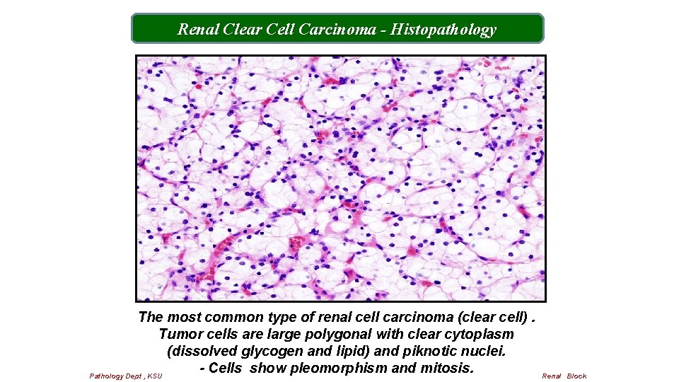 Renal Clear Cell Carcinoma - Histopathology The most common type of renal cell carcinoma