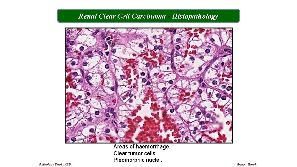 Renal Clear Cell Carcinoma - Histopathology Pathology Dept , KSU Areas of haemorrhage. Clear