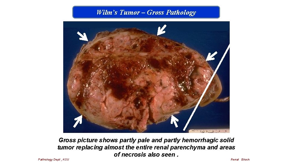 Wilm’s Tumor – Gross Pathology Gross picture shows partly pale and partly hemorrhagic solid