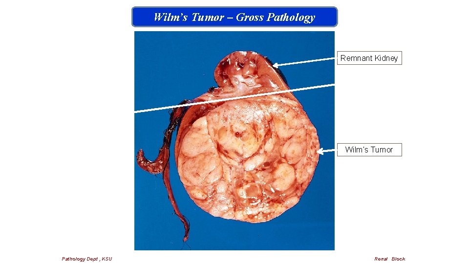 Wilm’s Tumor – Gross Pathology Remnant Kidney Wilm’s Tumor Pathology Dept , KSU Renal