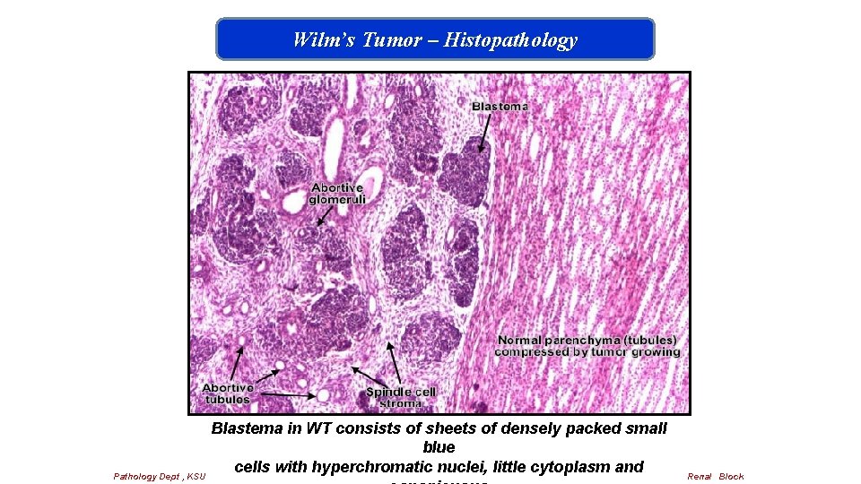 Wilm’s Tumor – Histopathology Blastema in WT consists of sheets of densely packed small