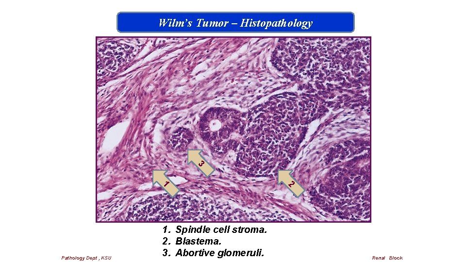 Wilm’s Tumor – Histopathology 3 2 1 Pathology Dept , KSU 1. Spindle cell
