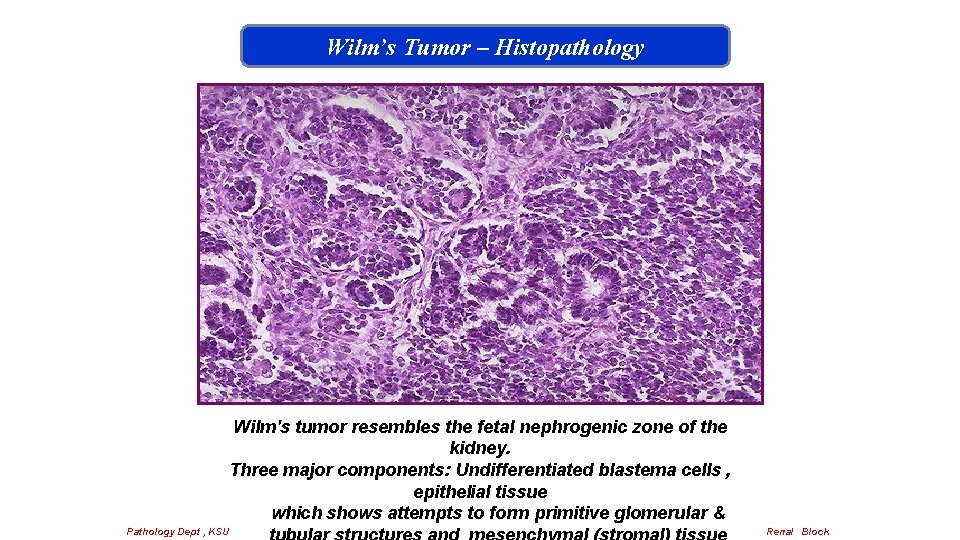Wilm’s Tumor – Histopathology Wilm's tumor resembles the fetal nephrogenic zone of the kidney.