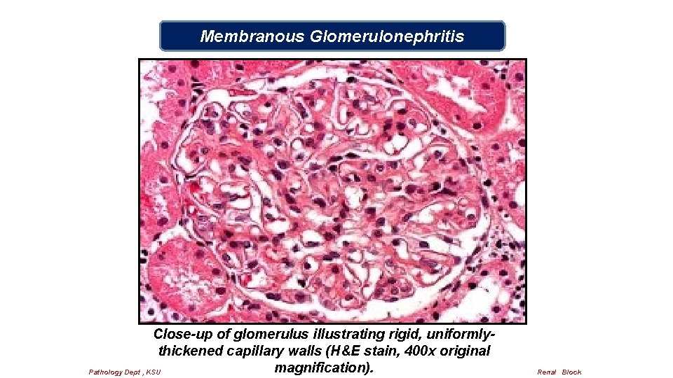 Membranous Glomerulonephritis Close-up of glomerulus illustrating rigid, uniformlythickened capillary walls (H&E stain, 400 x