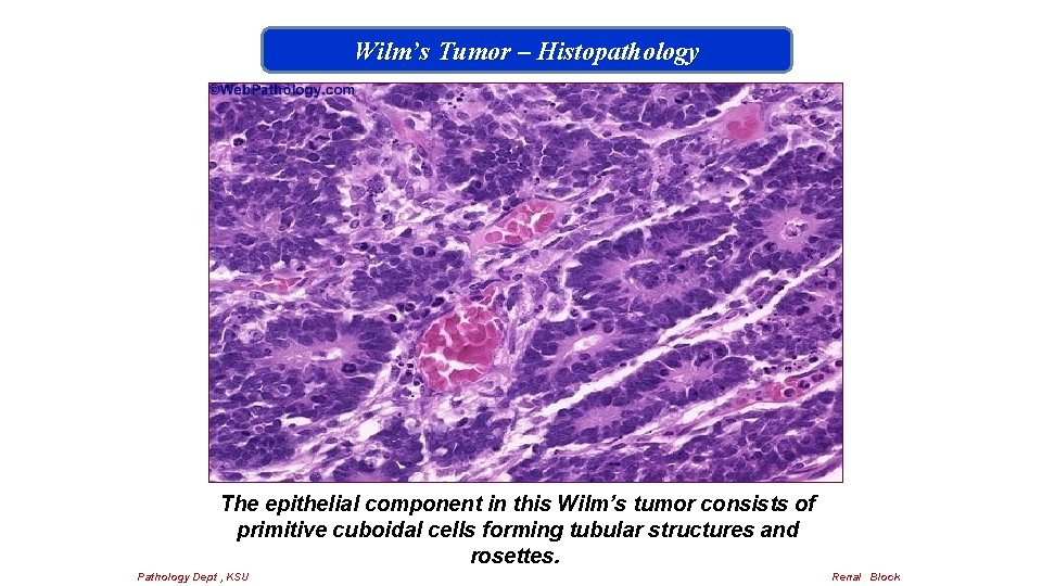 Wilm’s Tumor – Histopathology The epithelial component in this Wilm’s tumor consists of primitive