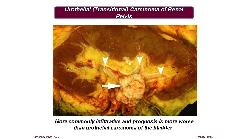  Urothelial (Transitional) Carcinoma of Renal Pelvis More commonly infiltrative and prognosis is more