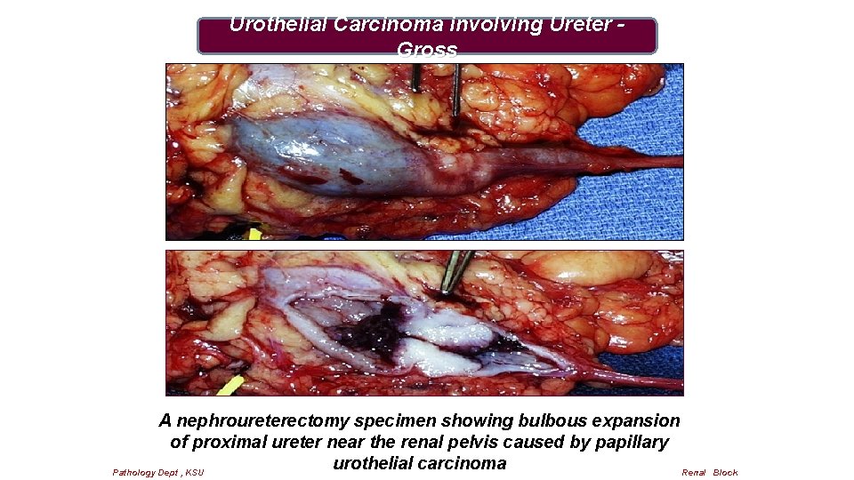 Urothelial Carcinoma involving Ureter - Gross A nephroureterectomy specimen showing bulbous expansion of proximal