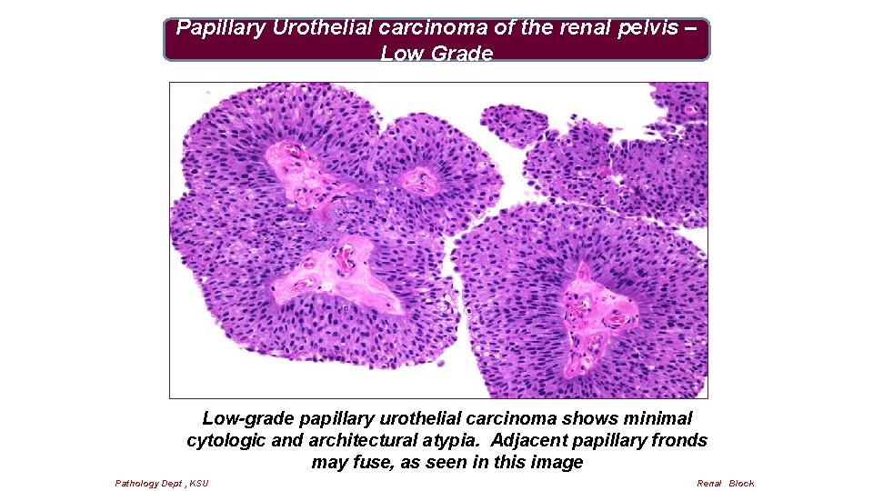 Papillary Urothelial carcinoma of the renal pelvis – Low Grade Low-grade papillary urothelial carcinoma