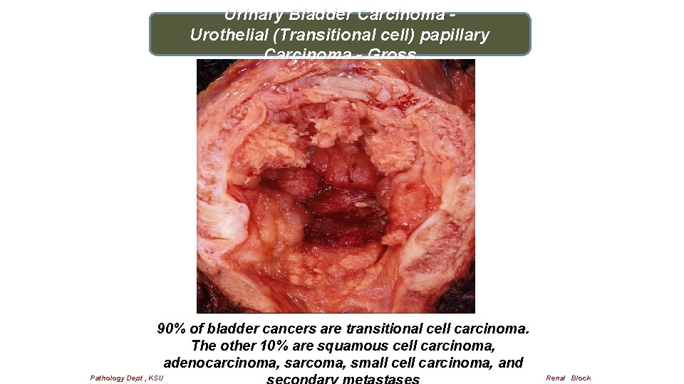 Urinary Bladder Carcinoma Urothelial (Transitional cell) papillary Carcinoma - Gross 90% of bladder cancers
