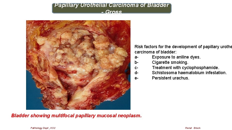 Papillary Urothelial Carcinoma of Bladder - Gross Risk factors for the development of papillary