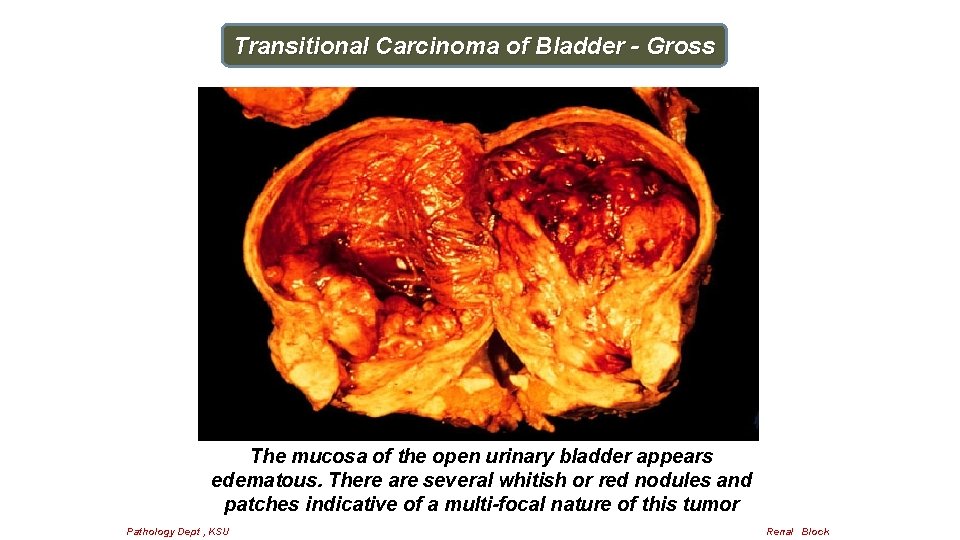 Transitional Carcinoma of Bladder - Gross The mucosa of the open urinary bladder appears
