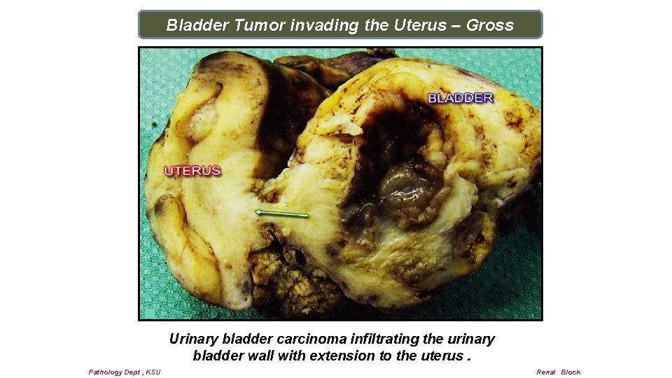 Bladder Tumor invading the Uterus – Gross Urinary bladder carcinoma infiltrating the urinary bladder