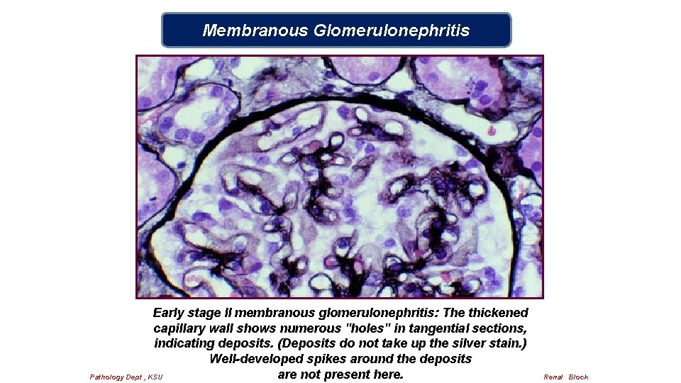 Membranous Glomerulonephritis Early stage II membranous glomerulonephritis: The thickened capillary wall shows numerous "holes"