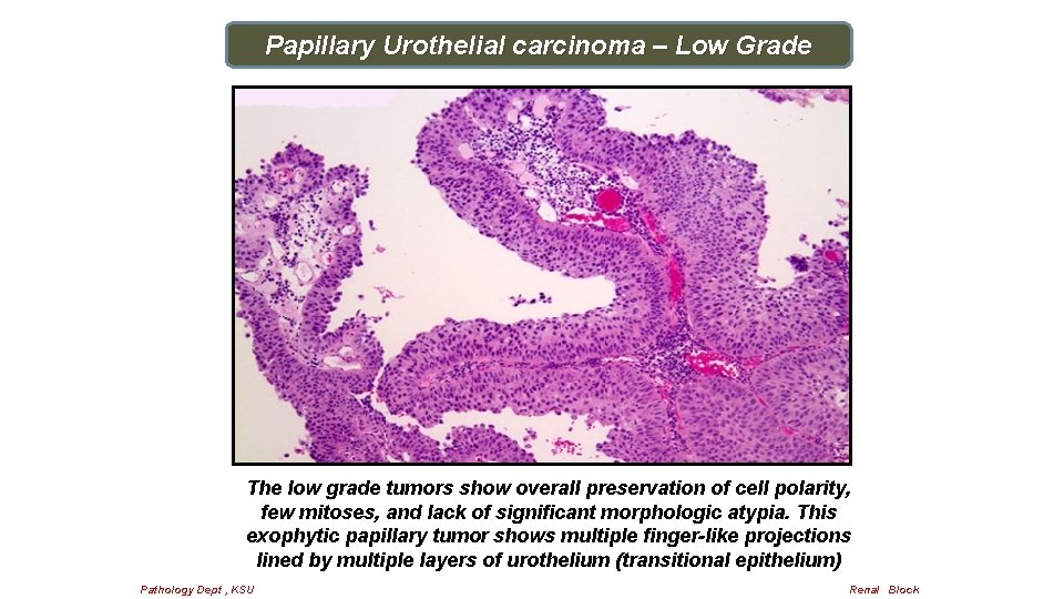 Papillary Urothelial carcinoma – Low Grade The low grade tumors show overall preservation of