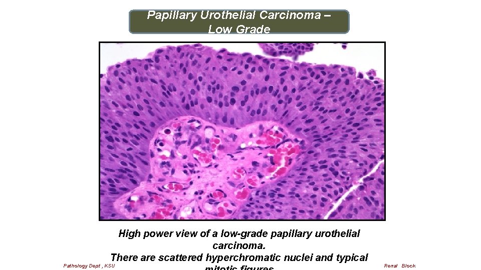 Papillary Urothelial Carcinoma – Low Grade High power view of a low-grade papillary urothelial