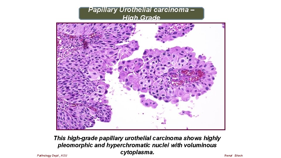 Papillary Urothelial carcinoma – High Grade This high-grade papillary urothelial carcinoma shows highly pleomorphic