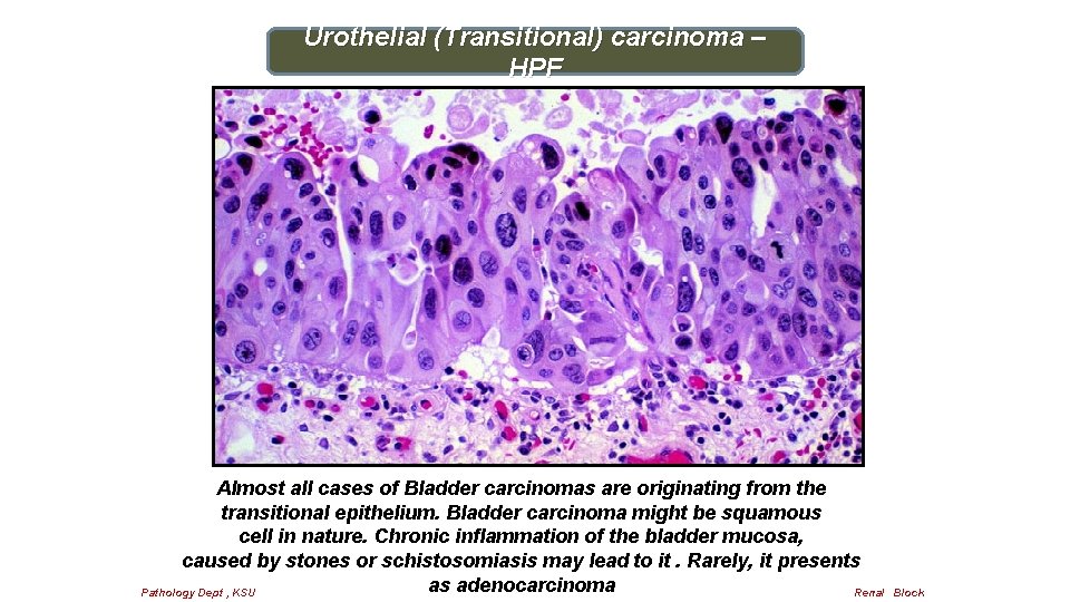 Urothelial (Transitional) carcinoma – HPF Almost all cases of Bladder carcinomas are originating from