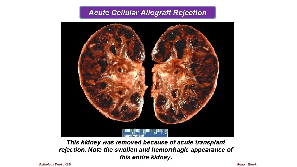 Acute Cellular Allograft Rejection This kidney was removed because of acute transplant rejection. Note