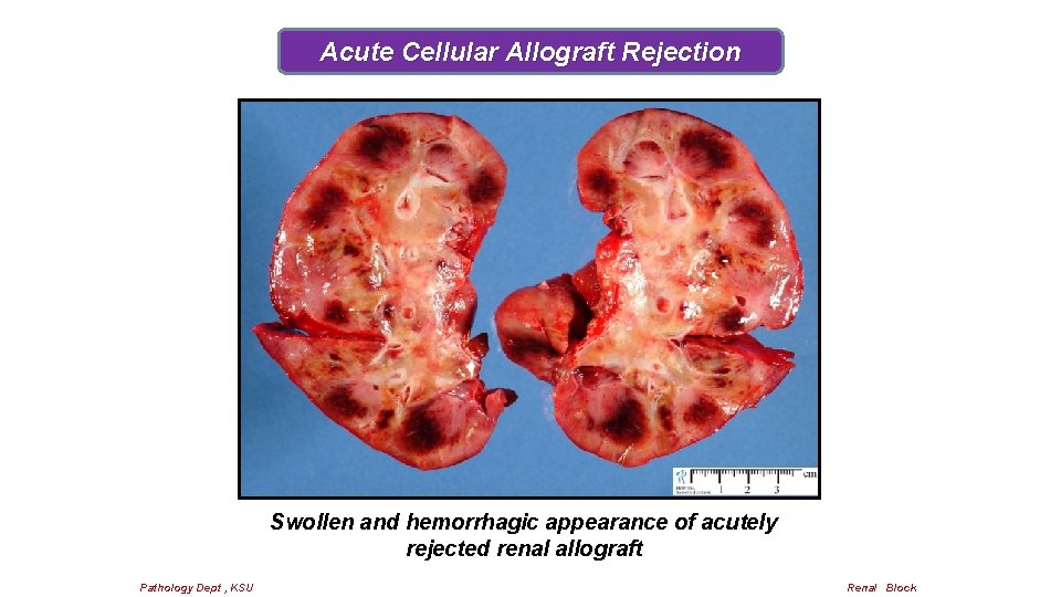 Acute Cellular Allograft Rejection Swollen and hemorrhagic appearance of acutely rejected renal allograft Pathology