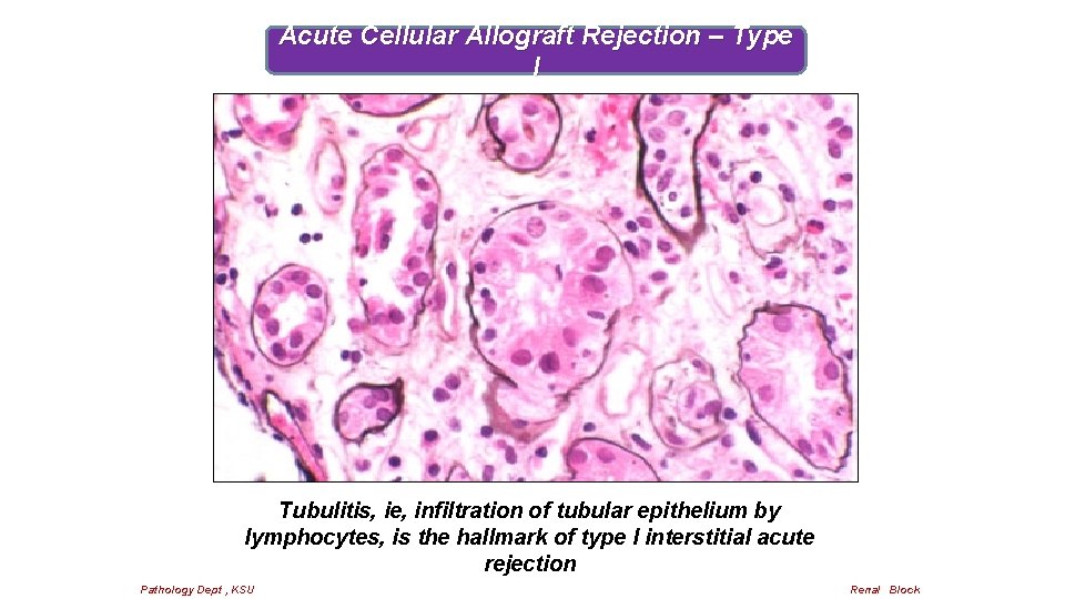 Acute Cellular Allograft Rejection – Type I Tubulitis, ie, infiltration of tubular epithelium by