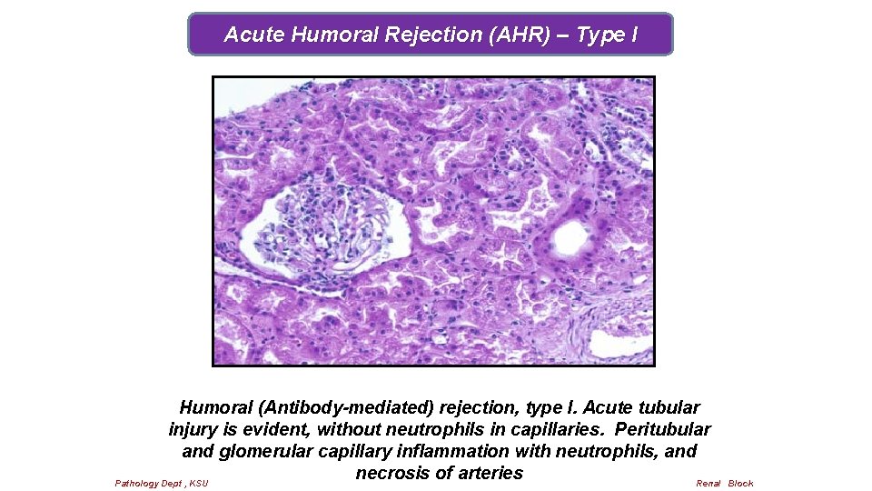 Acute Humoral Rejection (AHR) – Type I Humoral (Antibody-mediated) rejection, type I. Acute tubular