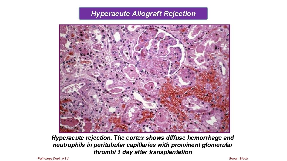 Hyperacute Allograft Rejection Hyperacute rejection. The cortex shows diffuse hemorrhage and neutrophils in peritubular