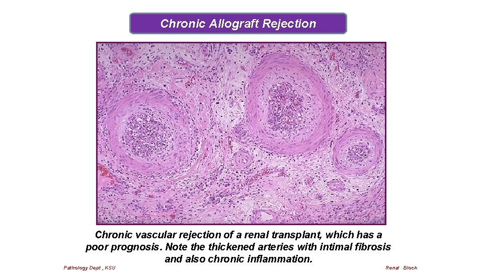 Chronic Allograft Rejection Chronic vascular rejection of a renal transplant, which has a poor