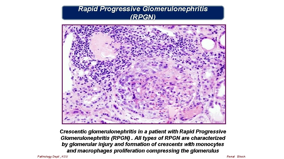 Rapid Progressive Glomerulonephritis (RPGN) Crescentic glomerulonephritis in a patient with Rapid Progressive Glomerulonephritis (RPGN).