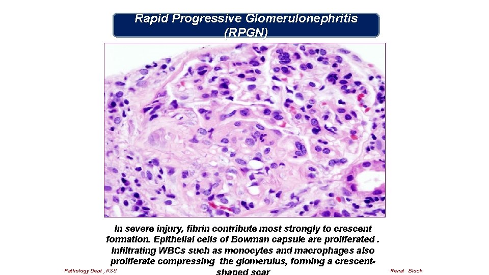 Rapid Progressive Glomerulonephritis (RPGN) In severe injury, fibrin contribute most strongly to crescent formation.