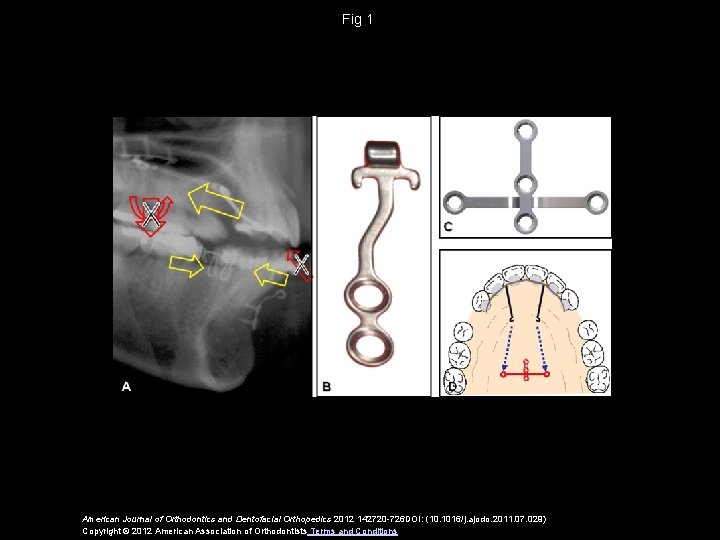 Fig 1 American Journal of Orthodontics and Dentofacial Orthopedics 2012 142720 -726 DOI: (10.