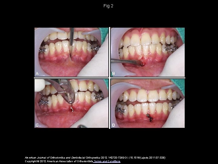 Fig 2 American Journal of Orthodontics and Dentofacial Orthopedics 2012 142720 -726 DOI: (10.