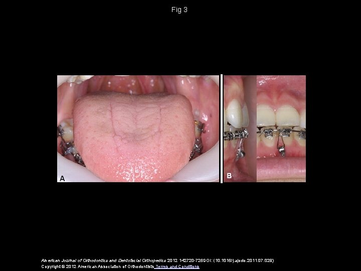 Fig 3 American Journal of Orthodontics and Dentofacial Orthopedics 2012 142720 -726 DOI: (10.