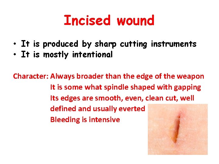 Incised wound • It is produced by sharp cutting instruments • It is mostly
