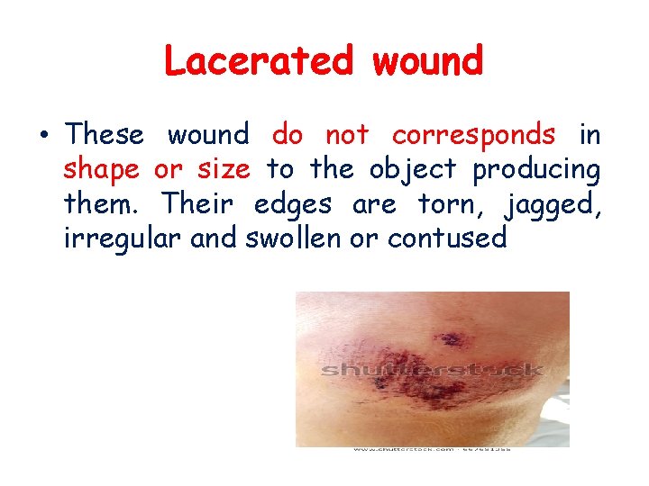 Lacerated wound • These wound do not corresponds in shape or size to the