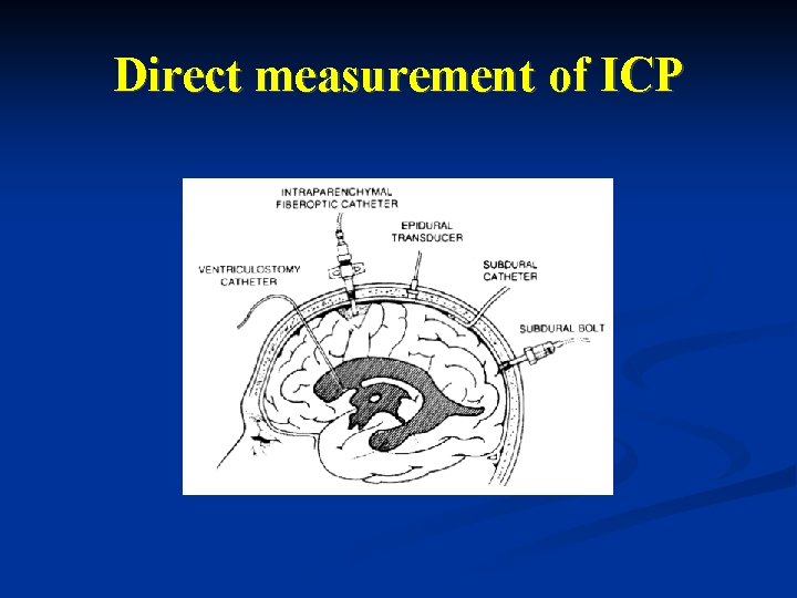 Direct measurement of ICP Direct measurement of ICP