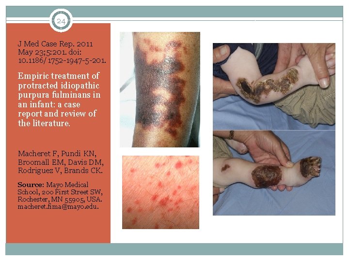 24 J Med Case Rep. 2011 May 23; 5: 201. doi: 10. 1186/1752 -1947