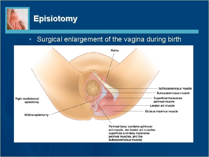 Episiotomy • Surgical enlargement of the vagina during birth 
