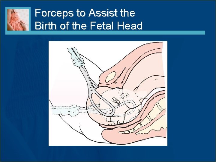 Forceps to Assist the Birth of the Fetal Head 